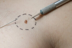 Tratamiento del cáncer de piel