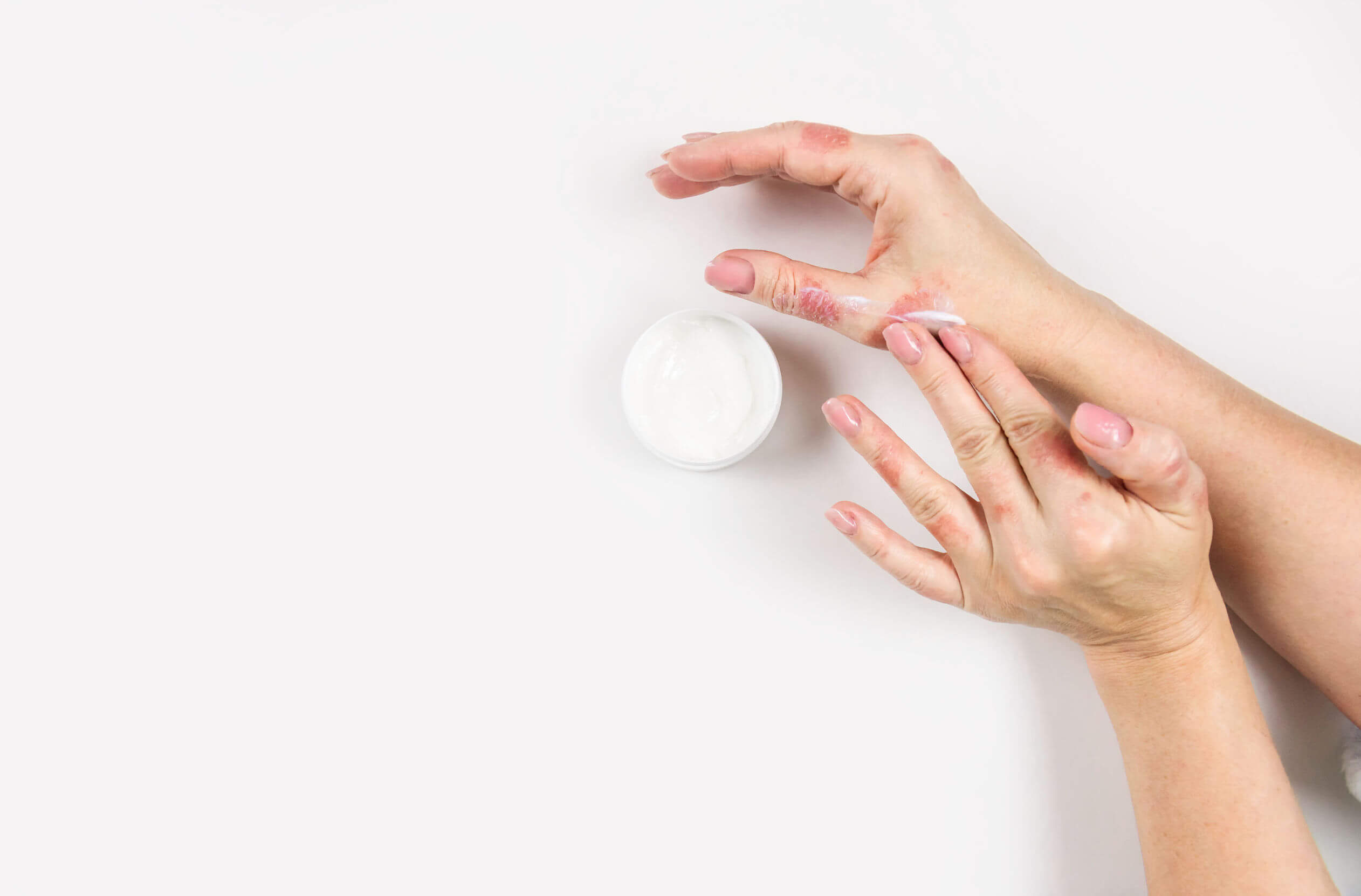 Ketoconazol: ¿qué es y para qué sirve?