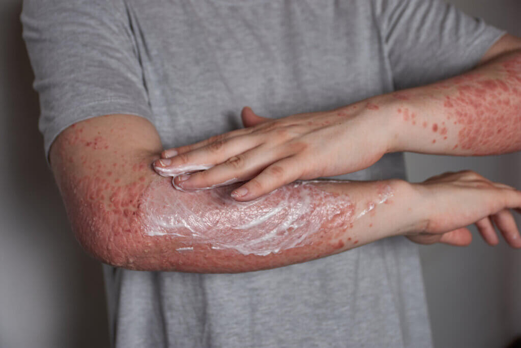 Skin allergy cream.