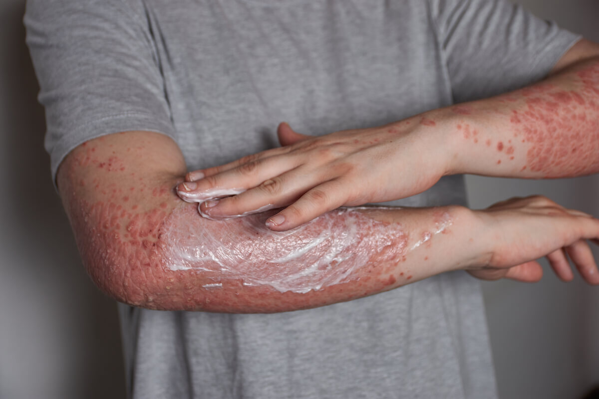 To cope with psoriasis it is necessary to take into account several factors
