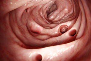 Diverticulitis: síntomas, causas y tratamiento