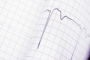 Diagnosis of Cardiac Arrhythmias