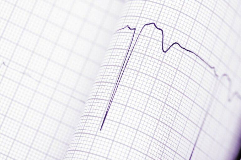 Diagnosis of Cardiac Arrhythmias