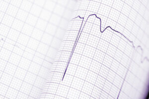 Diagnóstico de las arritmias cardíacas