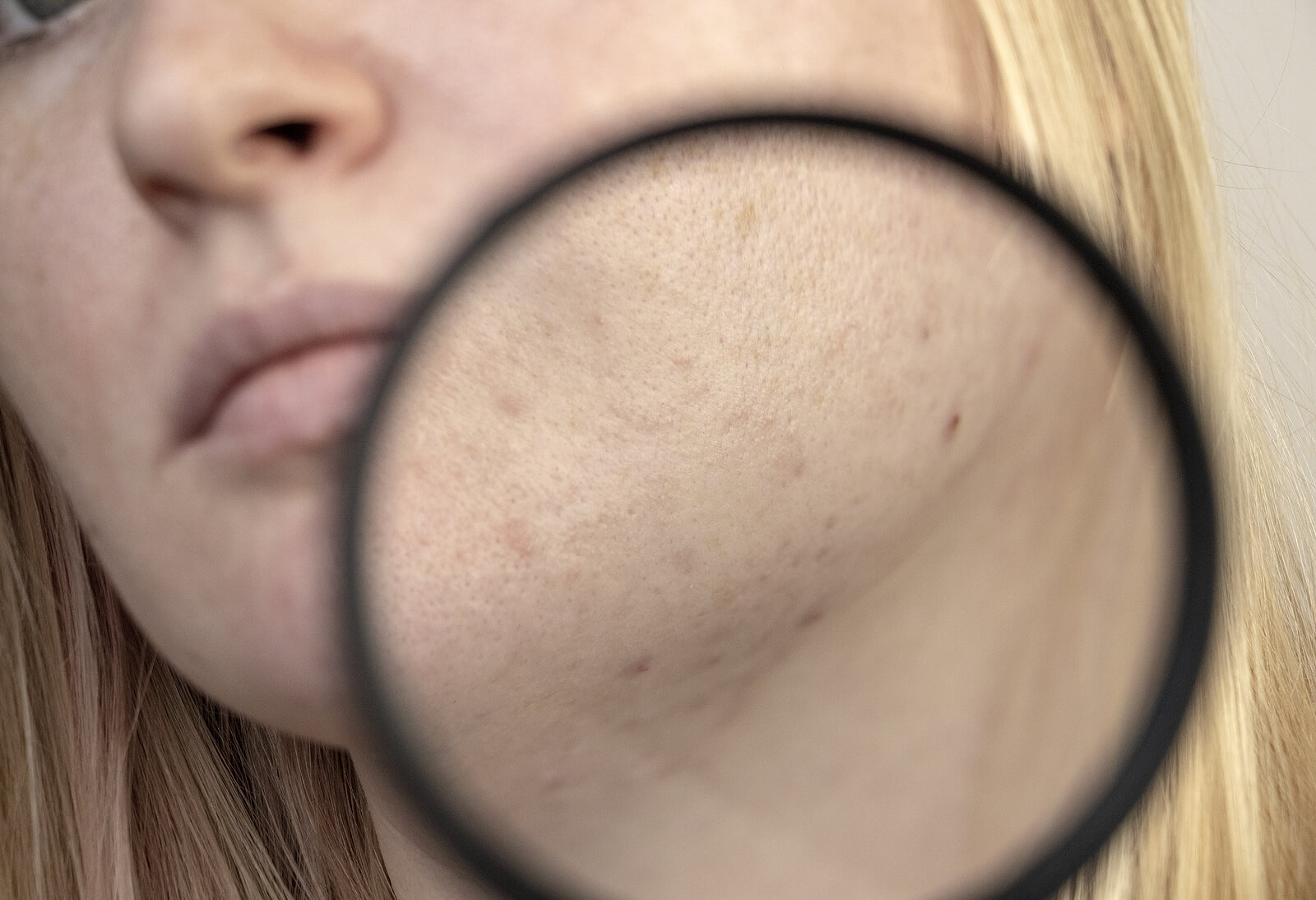 Os dutos das glândulas sebáceas podem ficar obstruídos e causar o desenvolvimento da acne.