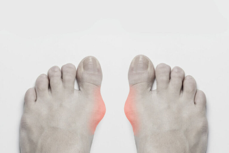 Gout: Symptoms, Causes and Treatment