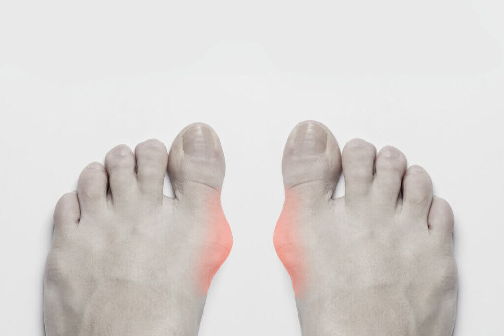 Gout: Symptoms, Causes and Treatment