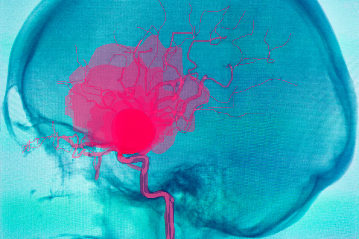 Los tipos de aneurismas más comunes incluyen los cerebrales