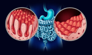 Anemia y celiaquía
