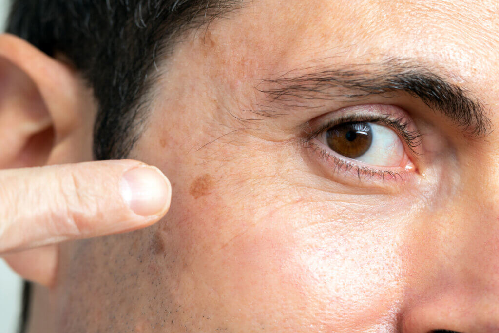 Kératose actinique sur le visage.