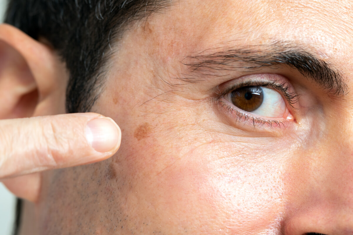 Las etapas del melanoma pueden producir cambios evidentes en la piel