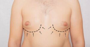 Gynecomastia: Symptoms, Causes and Treatment