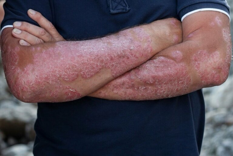 All About the Diagnosis of Psoriasis