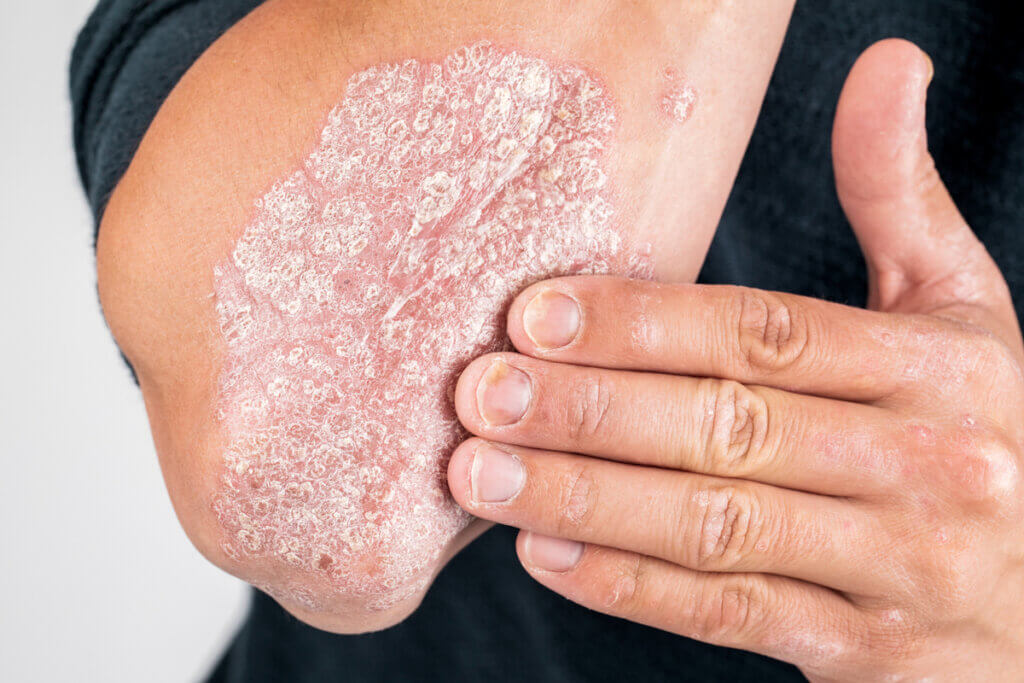 Los síntomas de la psoriasis