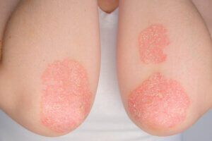 ¿Cuáles son las causas de la psoriasis?