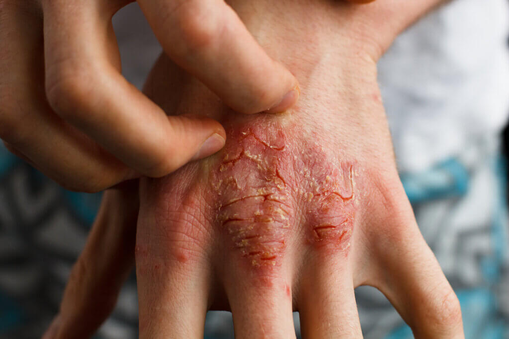 Síntomas de psoriasis en la mano.