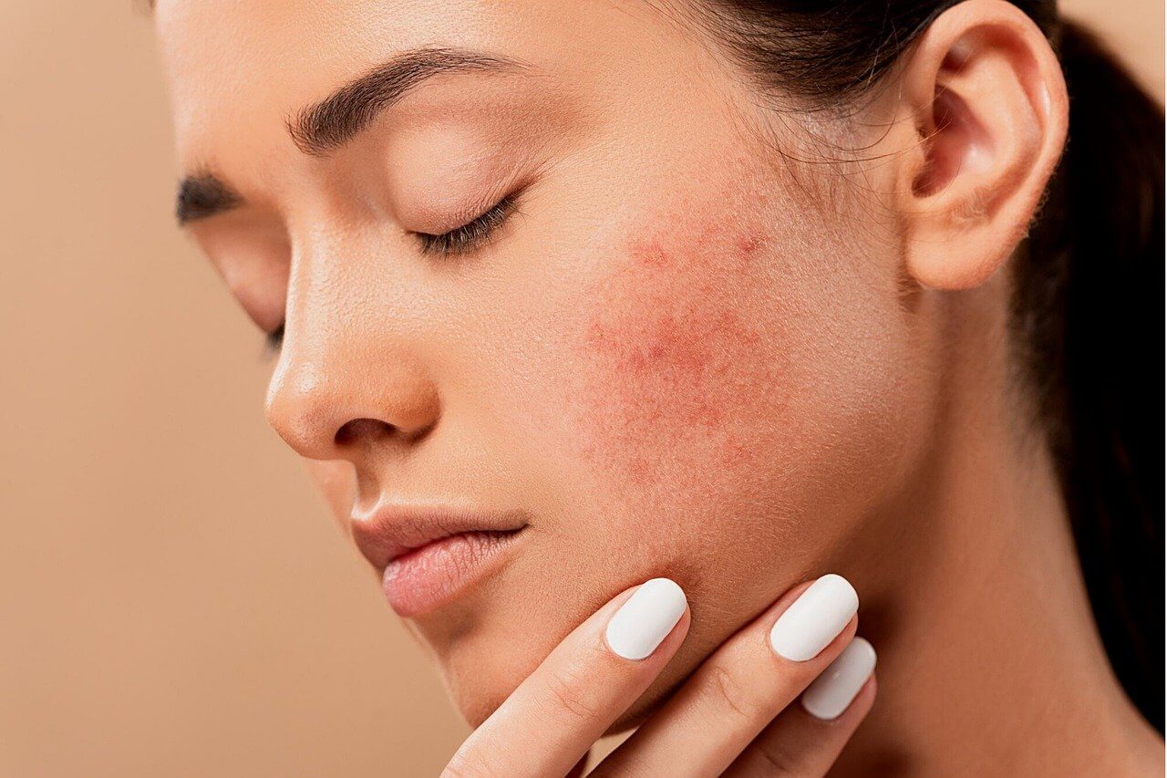 A acne pré-menstrual é muito comum.