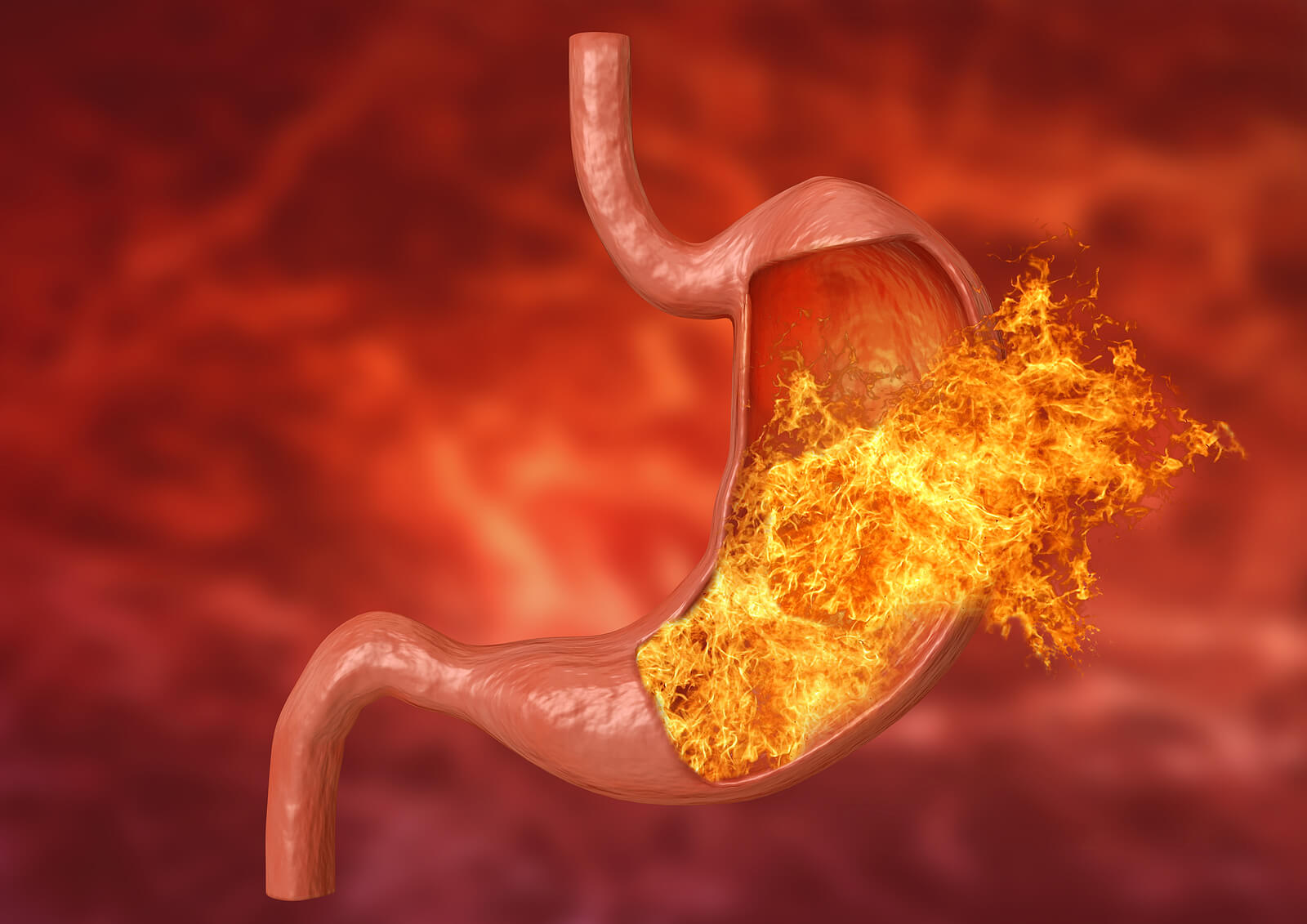 Las diferencias entre gastritis y gastroenteritis incluyen el dolor