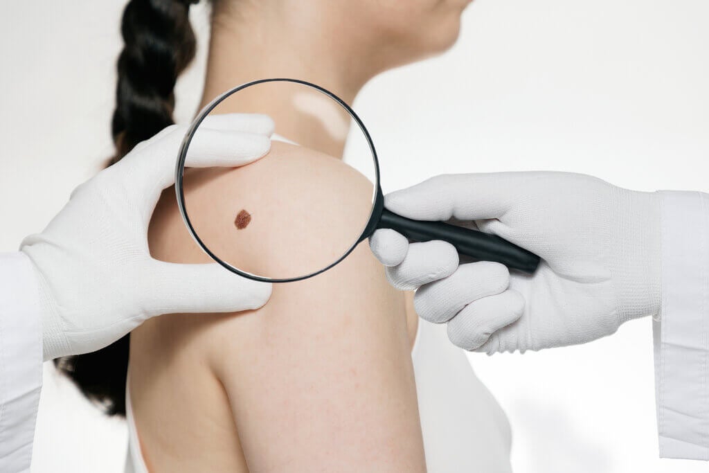 Symptoms of Skin Cancer