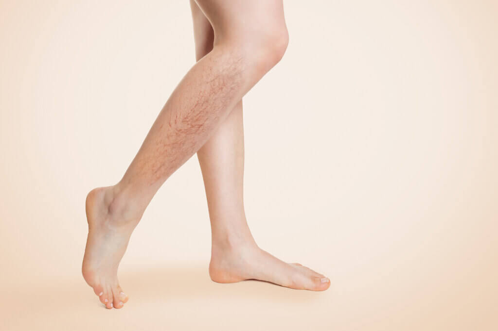 Varicose Veins: Symptoms, Causes, Prevention and Treatment