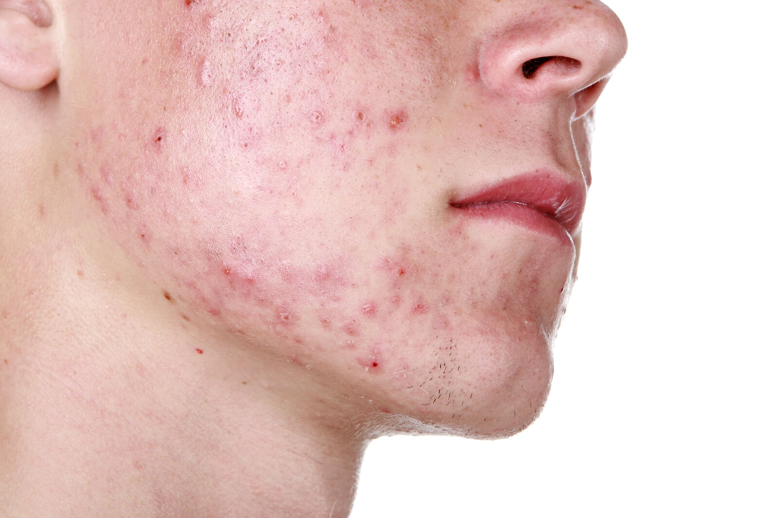 Sintomas de acne nodular.