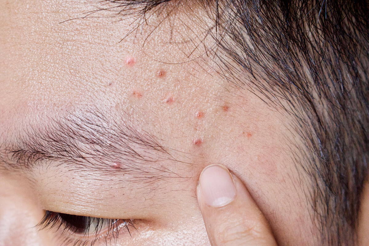 A água potável ajuda a tratar a acne, de acordo com alguns estudos