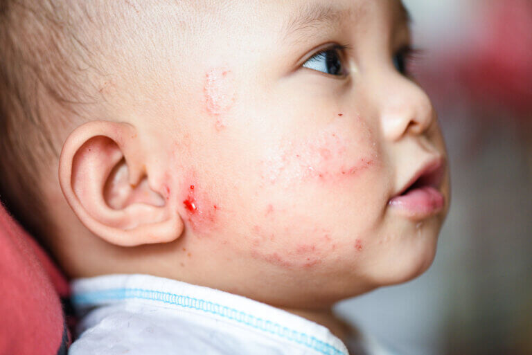 Todo sobre el acné infantil