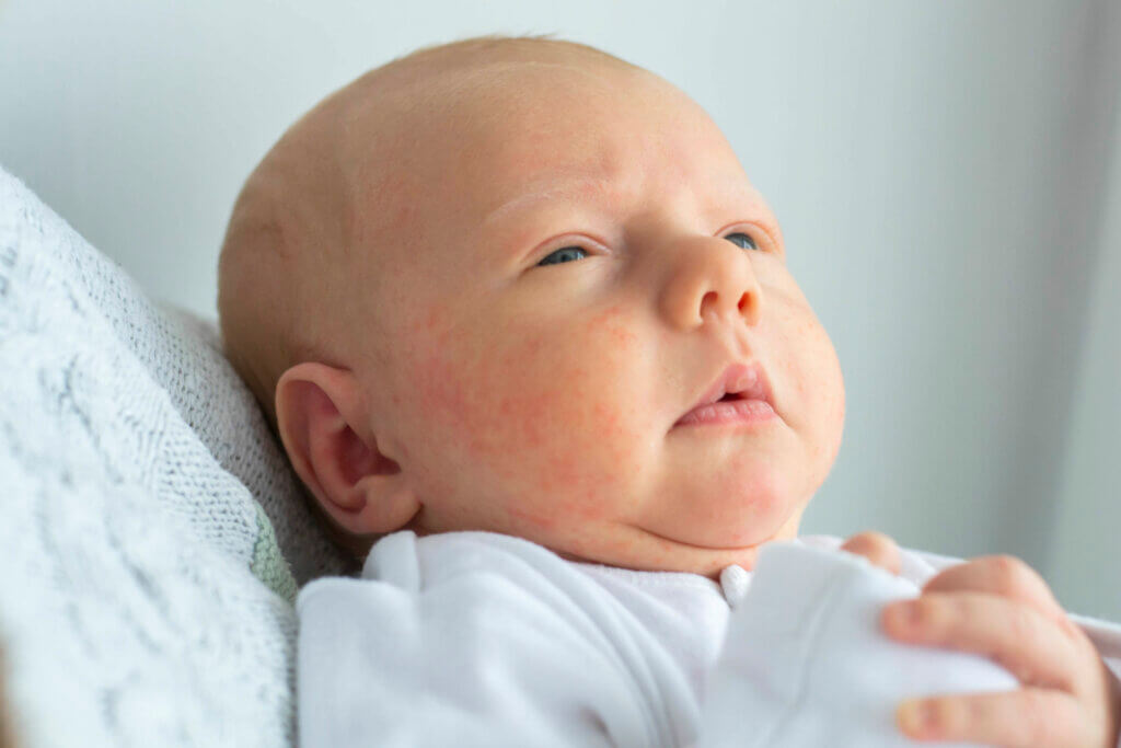 Acné neonatal: causas, síntomas y tratamiento