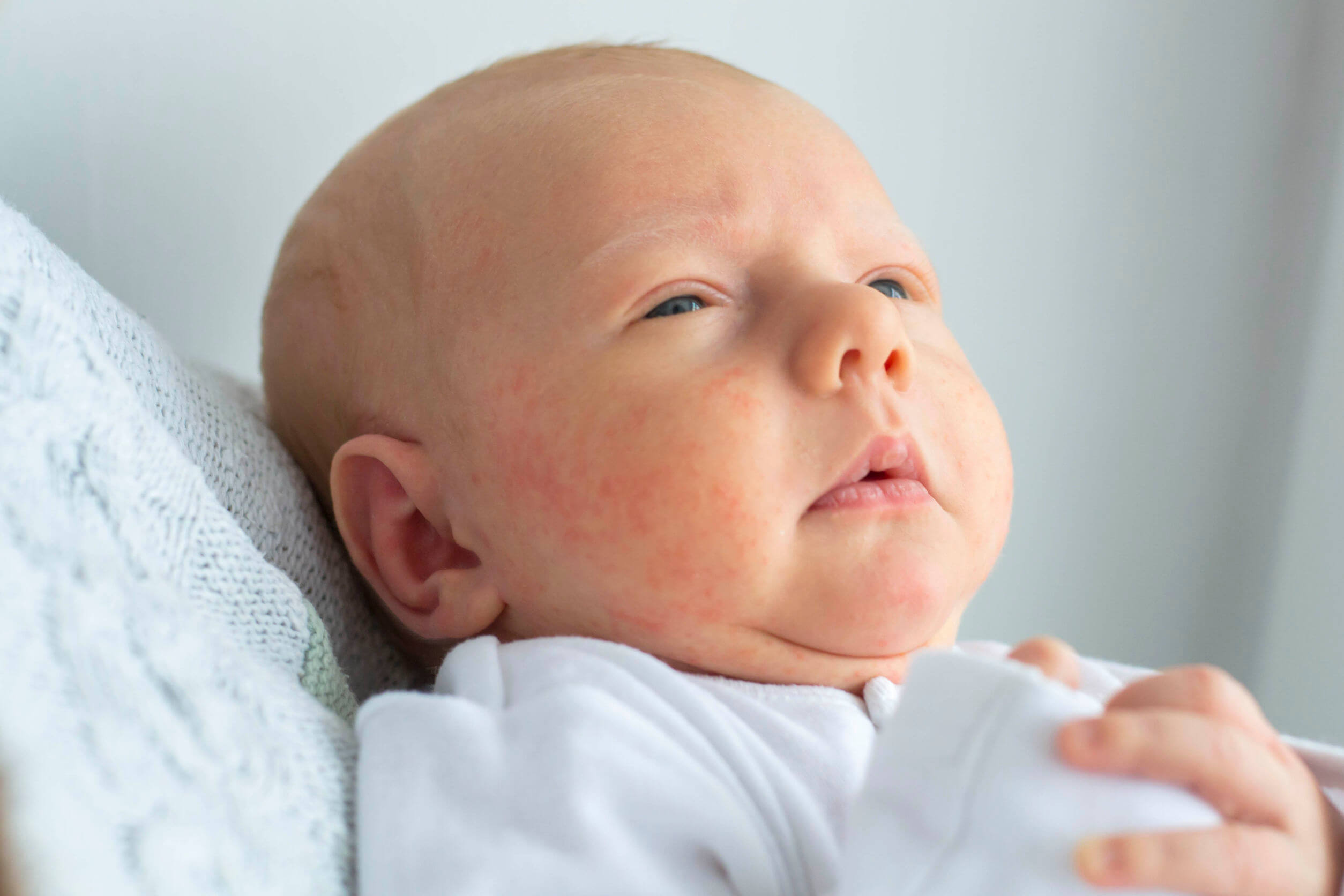 L'eczema nei bambini è comune