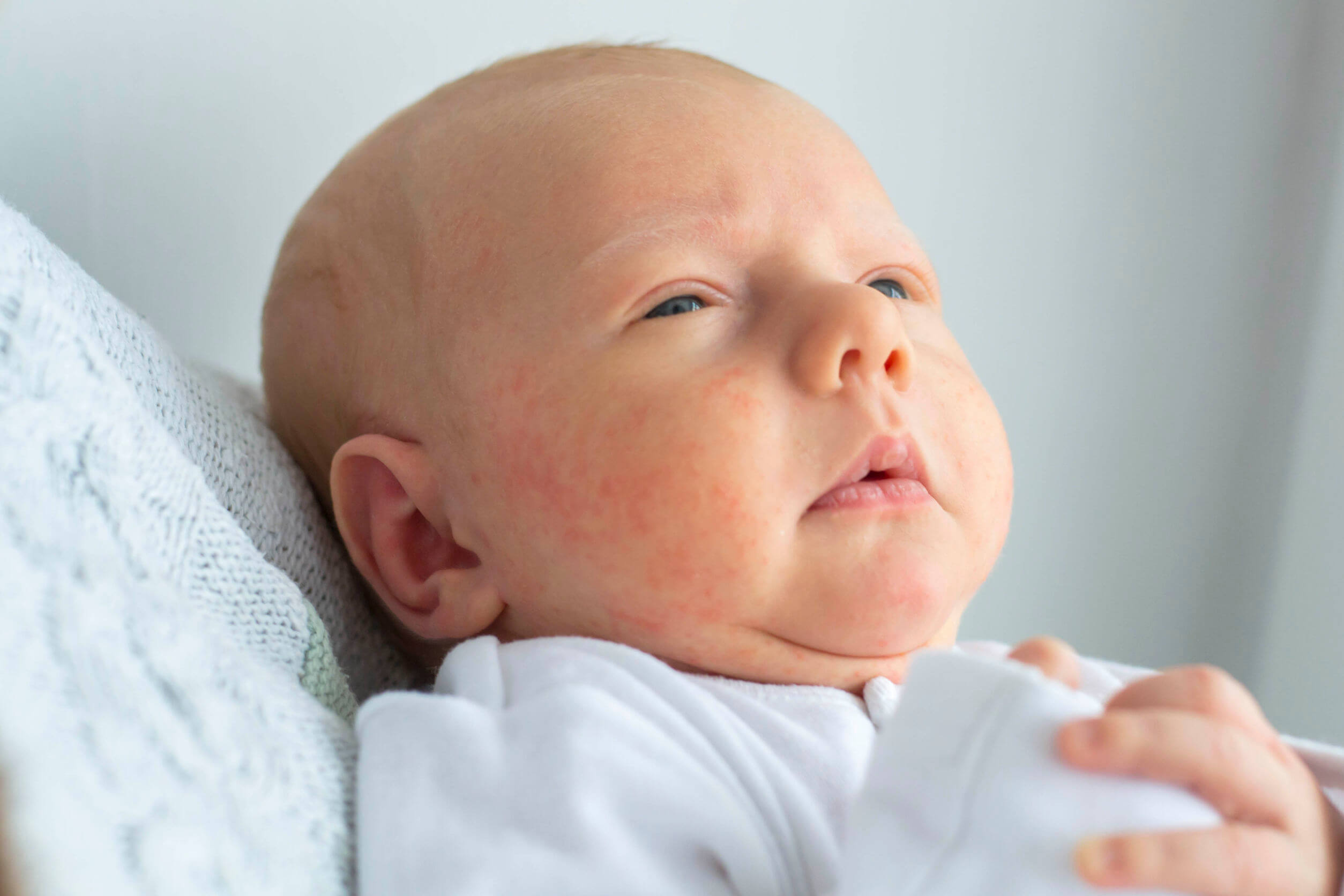 Eczema em bebês é comum