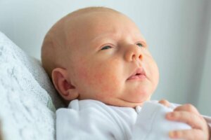 Acne neonatale: cause, sintomi e trattamento