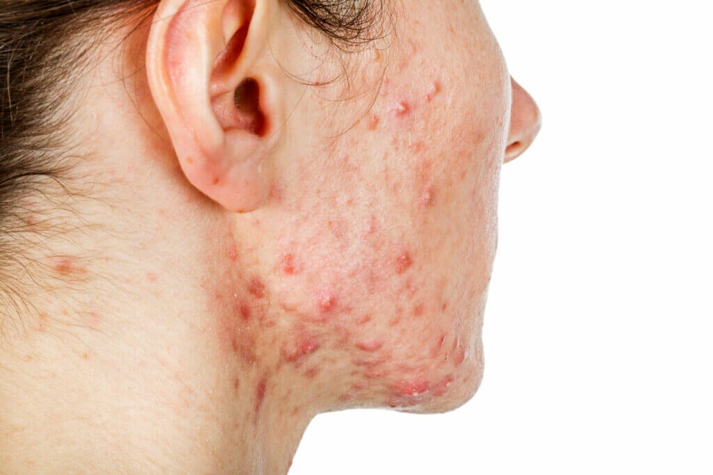 Nodular Acne: Everything You Need to Know