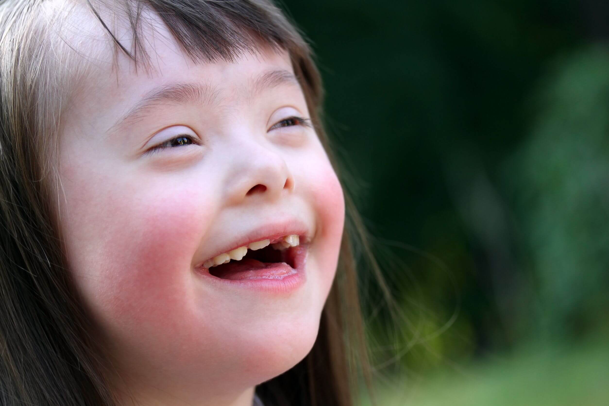 Causes of celiac disease include Down syndrome