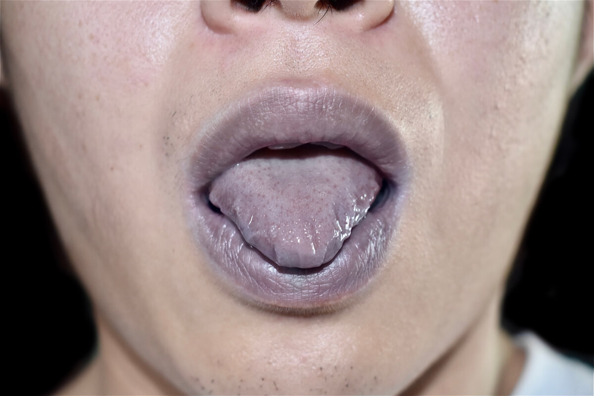 ¿Qué es la cianosis?