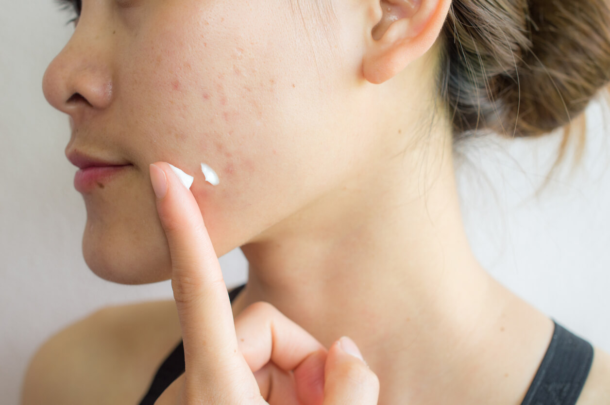 acne negli adulti: trattamento topico