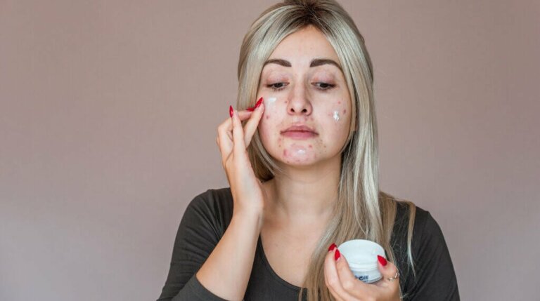 Causas mais comuns da acne em adultos