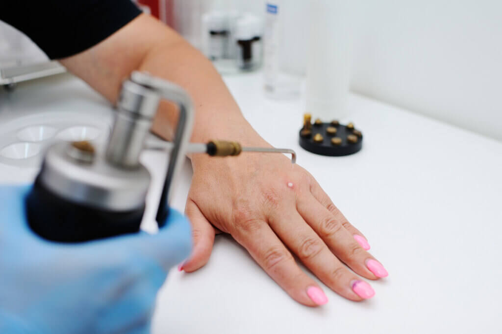 Crioterapia en dermatología.