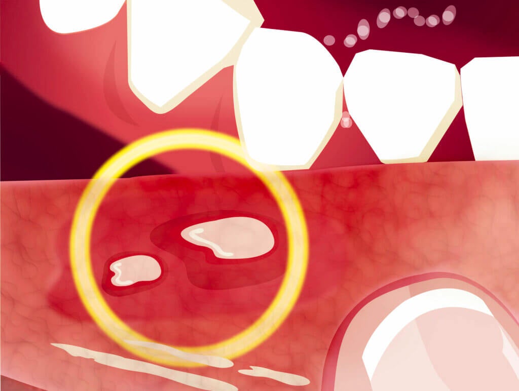 Como a doença celíaca afeta a saúde bucal?