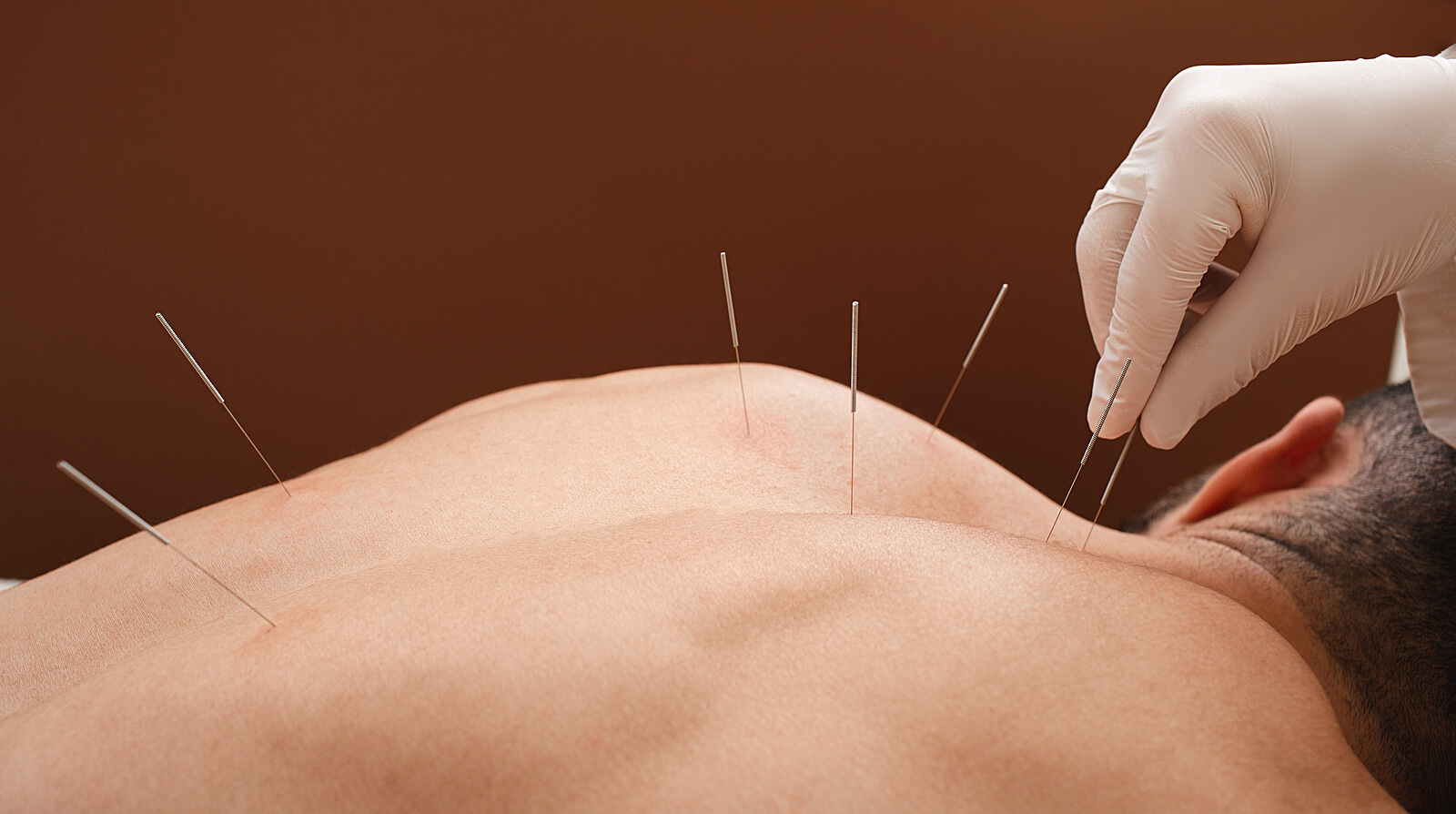 Acupuntura para la fibromialgia: esto dice la ciencia