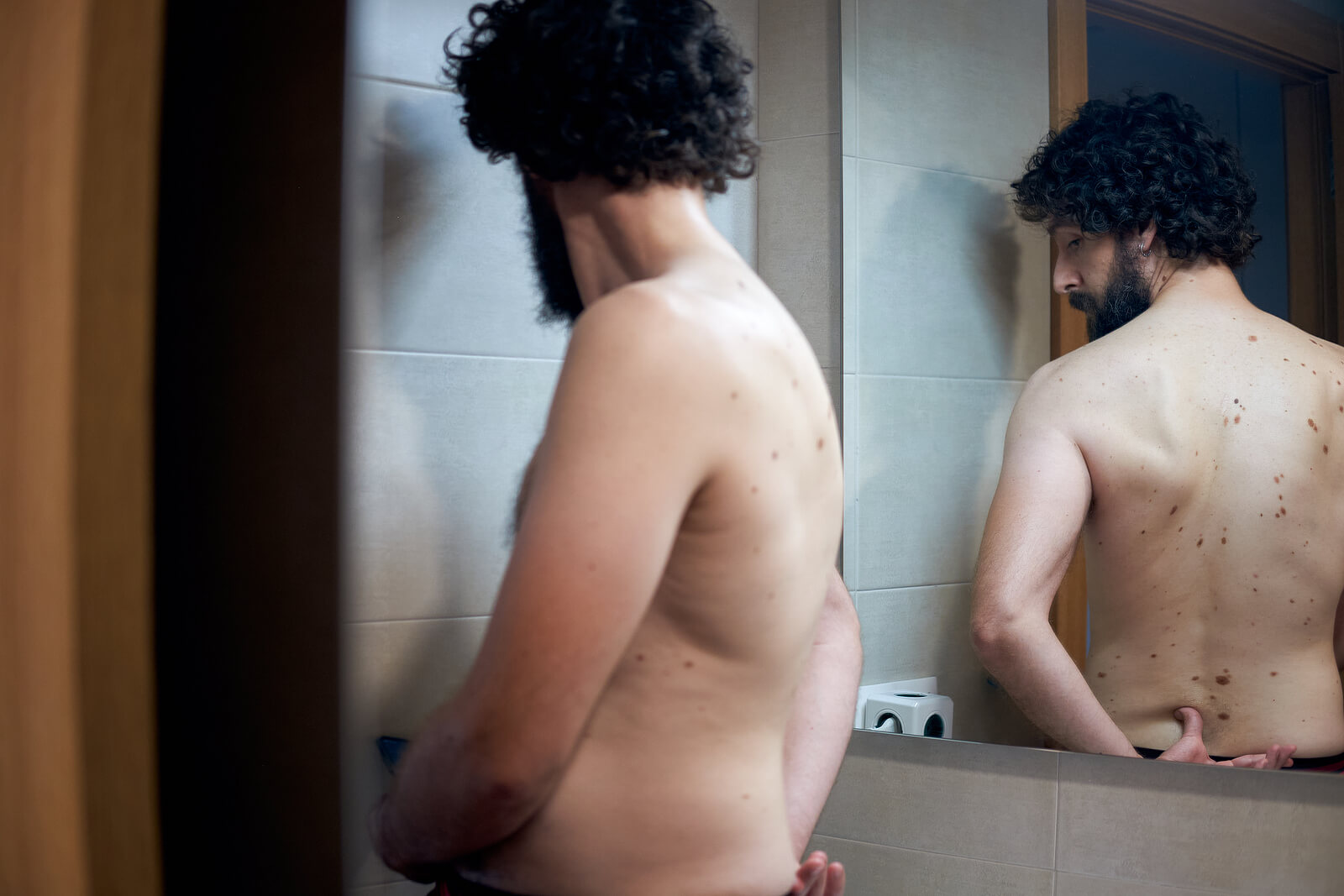 ¿Cómo saber si es cáncer de piel o un lunar?