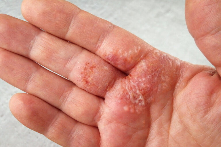 Dermatitis herpetiforme y celiaquía: ¿cómo se relacionan?