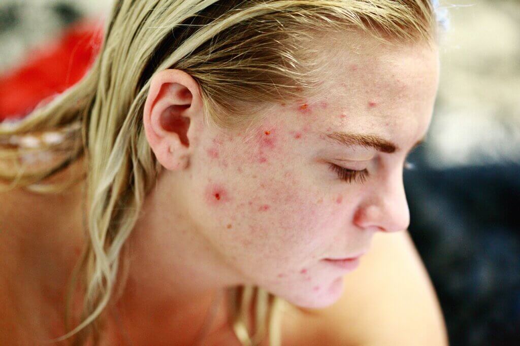 Cicatrices en el rostro con acné.