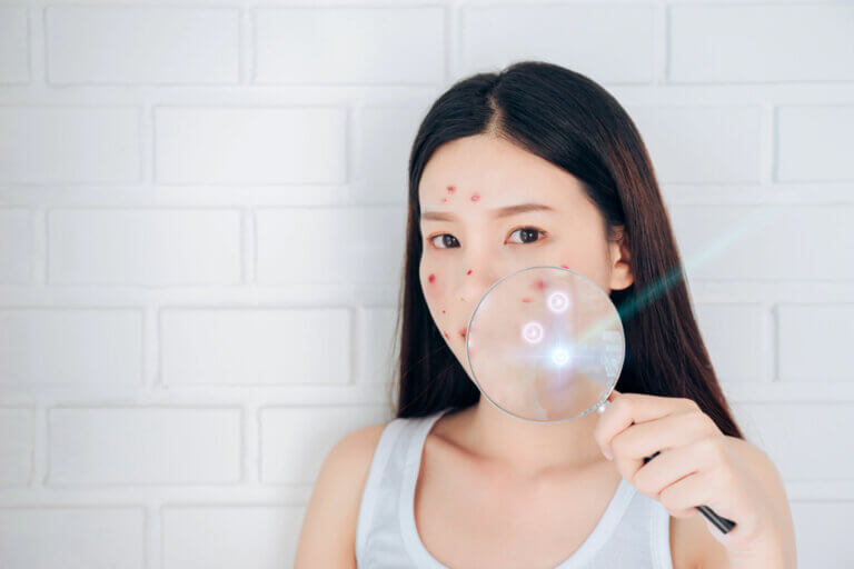 Hiperpigmentación posinflamatoria y acné: ¿cómo se relacionan?