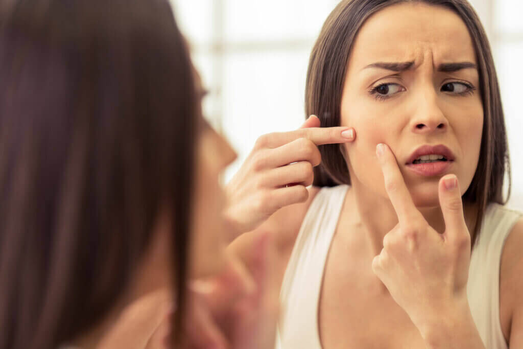 O que é acne leve e como ela é tratada?