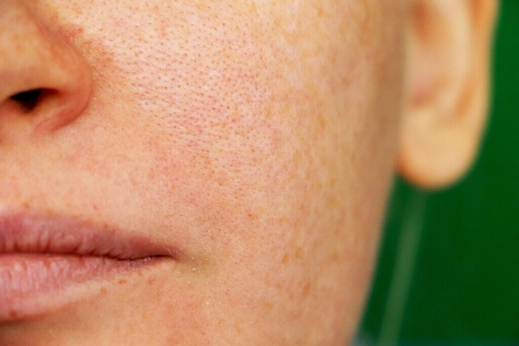 Is it Possible to Reduce Open Pores?