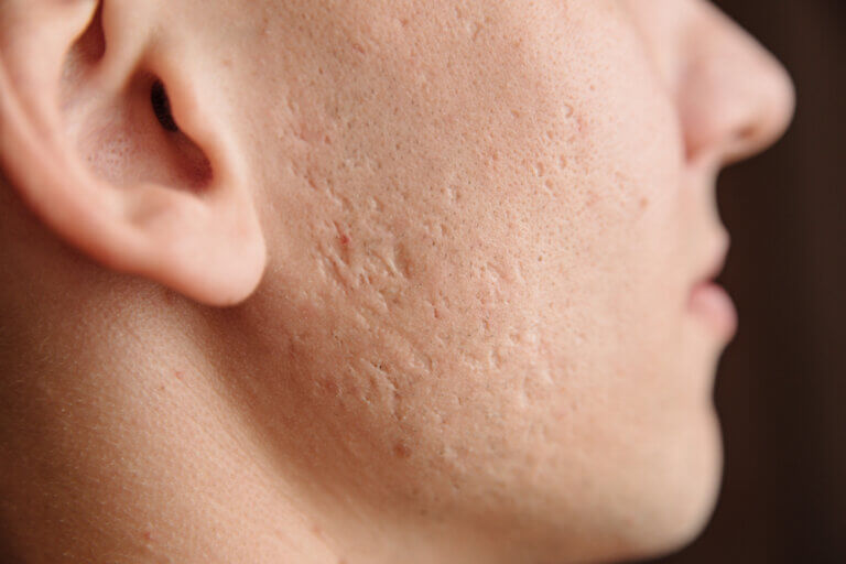 Cómo prevenir las cicatrices por acné