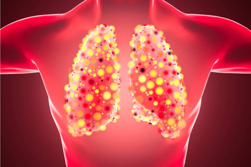 Pneumonia bilateral nos pulmões.