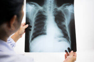 ¿Qué es la tuberculosis?