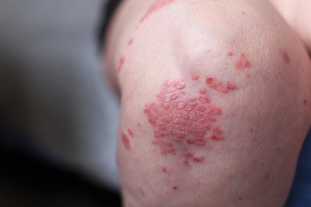 Artritis psoriásica: todo lo que debes saber