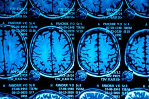 Pseudotumor cerebri o ipertensione endocranica idiopatica